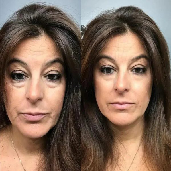 1+1 Gratis | Sofortige Lifting-Creme™ - Die Anti-Aging-Revolution für sofort straffere Haut! Online – Bild 2